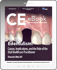 Edentulism: Causes, Implications, and the Role of the Oral Healthcare Practitioner eBook Thumbnail