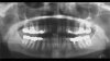 Fig 4. Radiographic imaging was used to establish vertical control of implant placement and ensure the presence of sufficient bone on either side of the implant.