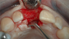 Fig 5. 1.5 mm of bone should surround the implant on either side.