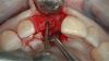 Fig 6. The location for implant placement can then be established using a round bur.