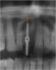 Fig 9. An enlarged panorex image with the direction-indicating pin in place was used to plan proper implant placement depth, particularly in the context of the exact height of bone.
