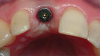 Fig 12. After implant insertion and torquing to 35 Ncm, a healing abutment was placed.