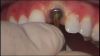 Fig 13. After osseointegration, the healing abutment was removed.