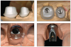 Fig 17. Custom abutments (top two images) and prefabricated stock abutments (bottom two images) are available for implant-supported restorations.