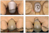 Fig 18. With cement-retained restorations, the abutment is first screwed and torqued into place (top two images), after which the crown restoration is cemented onto it (bottom two images).