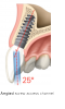 Fig 19. Angled screw-access channel 25 degrees from the long axis of the implant allows access hole to be placed on the lingual or cingulum.