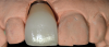 Fig 21. Based on the impression and other prescription information received, the laboratory creates necessary components for completing the implant-supported restoration and verifies fit on the model.
