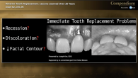 Anterior Immediate Tooth Replacement: Lessons Learned Over 20 Years Webinar Thumbnail