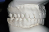 Figure 7D  This case is an example of the importance of evaluating the bite with the joints seated in a stable position. Orthodontic treatment was rendered to correct a 