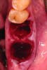 Fig 2. Atraumatic extraction of hopeless mandibular first and second molars.