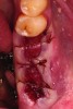 Fig 4. Intentional non-primary closure of surgical sites.