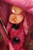 Fig 6. Placement of dental implants into healed bone. Note complete circumferential bone surrounding all aspects of the dental implants.