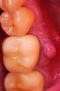 Fig 15. Case 3: Hopeless mandibular molar prior to extraction.