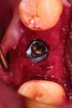 Fig 19. Placement of dental implant into healed bone. Note complete circumferential bone surrounding all aspects of the dental implant.
