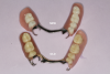 Fig 2. Differences are evident in the design of vintage complete dentures and removable partial dentures compared with current versions.
