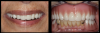 Fig 3. Left: Final complete maxillary denture, midline verified with facial esthetics. Teeth were within lip line. Right: Retracted view, dental midline 3⁄4 of a tooth off.