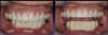 Fig 7. The treatment alternative chosen was scheduled serial extractions and immediate implant placement.