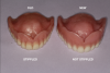 Fig 1. Differences are evident in the design of vintage complete dentures and removable partial dentures compared with current versions.