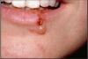 Figure 2 – Healing and active herpes lesions.Used with permission, Copyright 2006 Martin S. Spiller, D.M.D.
courtesy of Dr. Ed Cataldo