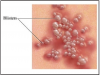 Figure 5 – Herpes Blisters