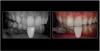 Fig 15. Smartphone dental photography can also be used in laboratory shade communication. In these images taken using MDP, the photo on the left shows value selection, while the one on the right shows chroma/hue selection.