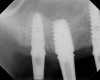 Fig 23. 6.5-month postoperative radiograph. Teeth Nos. 2 and 4 have been extracted and an immediate implant had been placed in the No. 4 position.