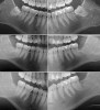 Fig 9. Radiographs taken presurgically (top) of one of the cases in the study group demonstrated impacted mandibular third molars; 3 months after surgery and grafting (middle) bone fill was seen in the grafted sites; at 12 months post-surgery (bottom) maintenance of the grafted sites was demonstrated.
