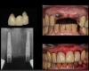 Fig 6. Ti-base abutments were seated
and verified with a periapical radiograph, and a PMMA provisional
placed on the same day and secured by screw retention.