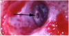 Fig 16. An apical endodontic surgical procedure being performed using the videoscope instead of a surgical microscope. The apex has been resected, flattened, and stained blue
to evaluate for fractures. The canal (arrow) has been prepared for apical fill. The videoscope is much easier to manipulate than a surgical microscope for this procedure.