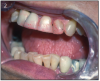 Figure 2 – The lips, tongue and all mucosal surfaces are dry in this patient with Sjögren’s syndrome. Note also the erosion and the presence of epithelial debris on the teeth, a sign of diminished salivary secretions.