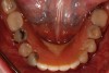 The patient’s mandibular arch included six remaining teeth and an interim partial denture.