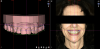 Fig 1. Intraoral scanning can be integrated with 2D images and videography to overlay a restorative plan on a patient’s photograph.