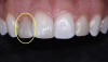 Fig 2. Preoperative (left) and preparation photograph (right) showing volume of tooth structure removed for this indirect treatment of black triangles. (Case courtesy of Dr. Charles Regalado)