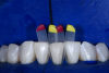 Fig 8. 8-year follow-up showing the possible integrity and color stability of injection-molded restorations. (Case courtesy Dr. David Clark)