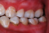 (23.) Teenage patient who had SDF applications every four months for 16 months. Flossing compliance was poor, and several teeth will require restorative care.