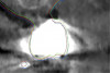 Fig 14. Close-up view at the level of the maxillary right first molar shown in Fig 12 with the outlines of the registered STL stone models to the CBCT anatomy, using various methods. Green outline: automatic registration plus manual fine-tuning, no scanning appliance. Red outline: landmark registration using a scanning appliance that was CBCT scanned; in this case the STL file of the model teeth was first produced by DICOM to STL conversion, and the registration to the CBCT anatomy followed. Blue outline: landmark registration using a scanning appliance that was CBCT scanned; in this case the registration was accomplished based on the voxels of the glass beads of the scanning appliance, and then the STL file of the stone model was produced. Differences of up to 1 mm can be noted among the three methods.