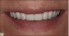 Fig 13. Final complete denture.